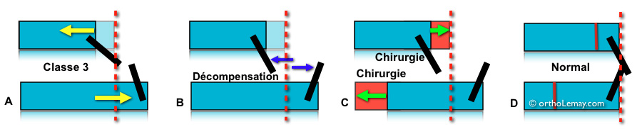 Décompensation dentaire orthodontique et chirurgie orthognathique pour une classe 3 squelettique