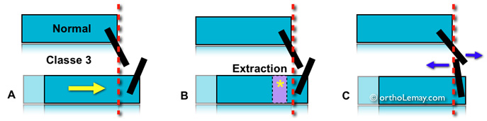 Classe 3 squelettique avec légère prognathi mandibulaire et extraction 