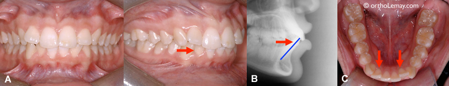 Compensation dento-alvéolaire pour une malocclusion classe 2