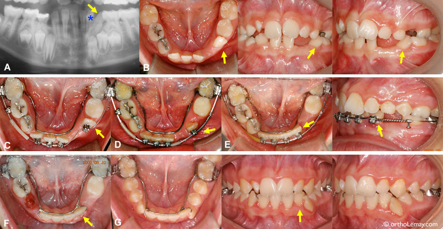 Eruption ectopique et correction orthodontique 