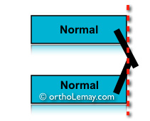 Normal Class I, jaw relationship