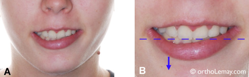 Sourire asymétrique causé par un dégagement inégal de la lèvre inférieure.