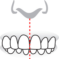 alignement de la ligne médiane dentaire