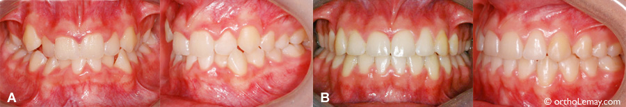 Correction des lignes médianes et de l'encombrement dentaire en orthodontie