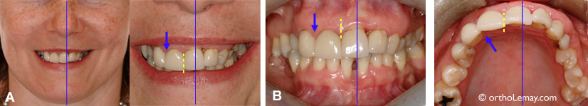 Déviation sévère de la ligne médiane et malocclusion dentaire. 