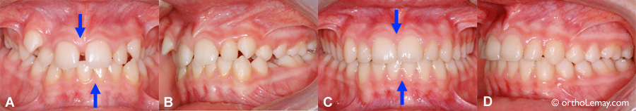 Correction orthodontique des lignes médianes dentaires.