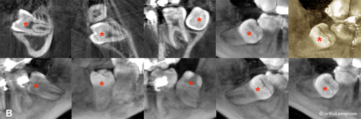 CBCT radiographie molaire incluse orthodontie