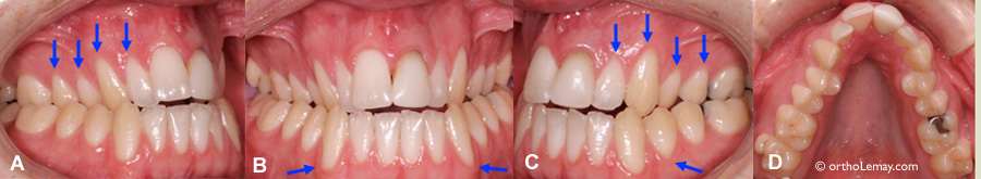 Récession gingivale ou déchaussement présents avant le début d'un traitement d'orthodontie. Malocclusion dentaire; déficience maxillaire transverse, contraction maxillaire. Peut nécessiter une greffe de gencive