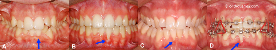 Déchaussement et récession gingivale apparus pendant un traitement d'orthodontie. 