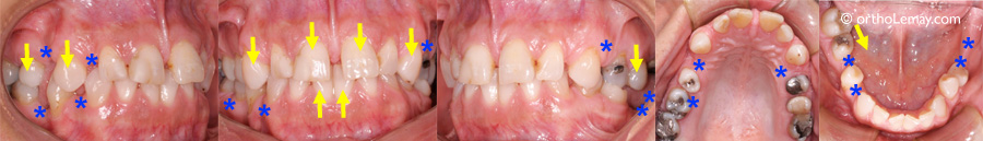 Affaissement postérieur de l'occlusion (posterior bite collapse) suite  la perte de dents. 