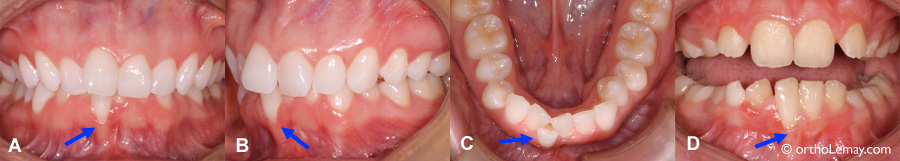Malposition dentaire et récession gingivale avant un traitement d'orthodontie. Déchaussement de gencive. 