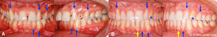 Niveau de gencive et récession gingivale stables après un traitement d'orthodontie.