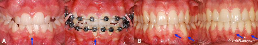 Récession ou déchaussement de gencive stable pendant l'orthodontie 