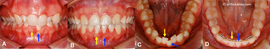 Récession gingivale stable pendant l'orthodontie 