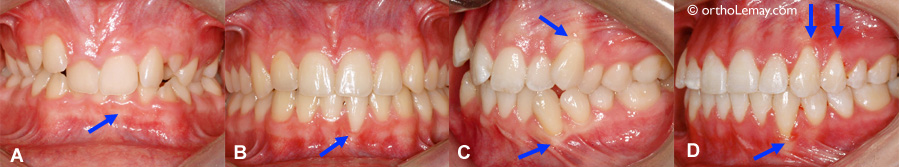 Déchaussement de gencive (récession gingivale) apparue pendant l'orthodontie 