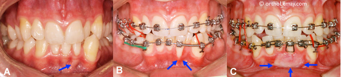 Récession de gencive et greffe gingivale pendant un traitement d'orthodontie 
