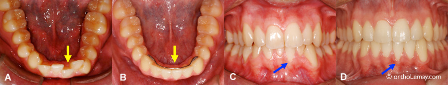 Récession gingivale ou déchaussement dentaire apparu pendant l'alignement des dents en orthodontie. 