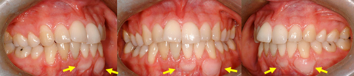 Greffe de gencive prophylactique avant un traitement d'orthodontie.