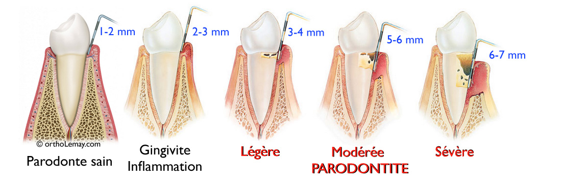 Le sondage parodontal permet d'évaluer la santé du parodonte (os et gencive) entourant les dents. 