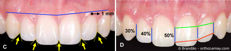 Proportions et positions des dents antérieures supérieures pour optimiser l'esthétique du sourire,