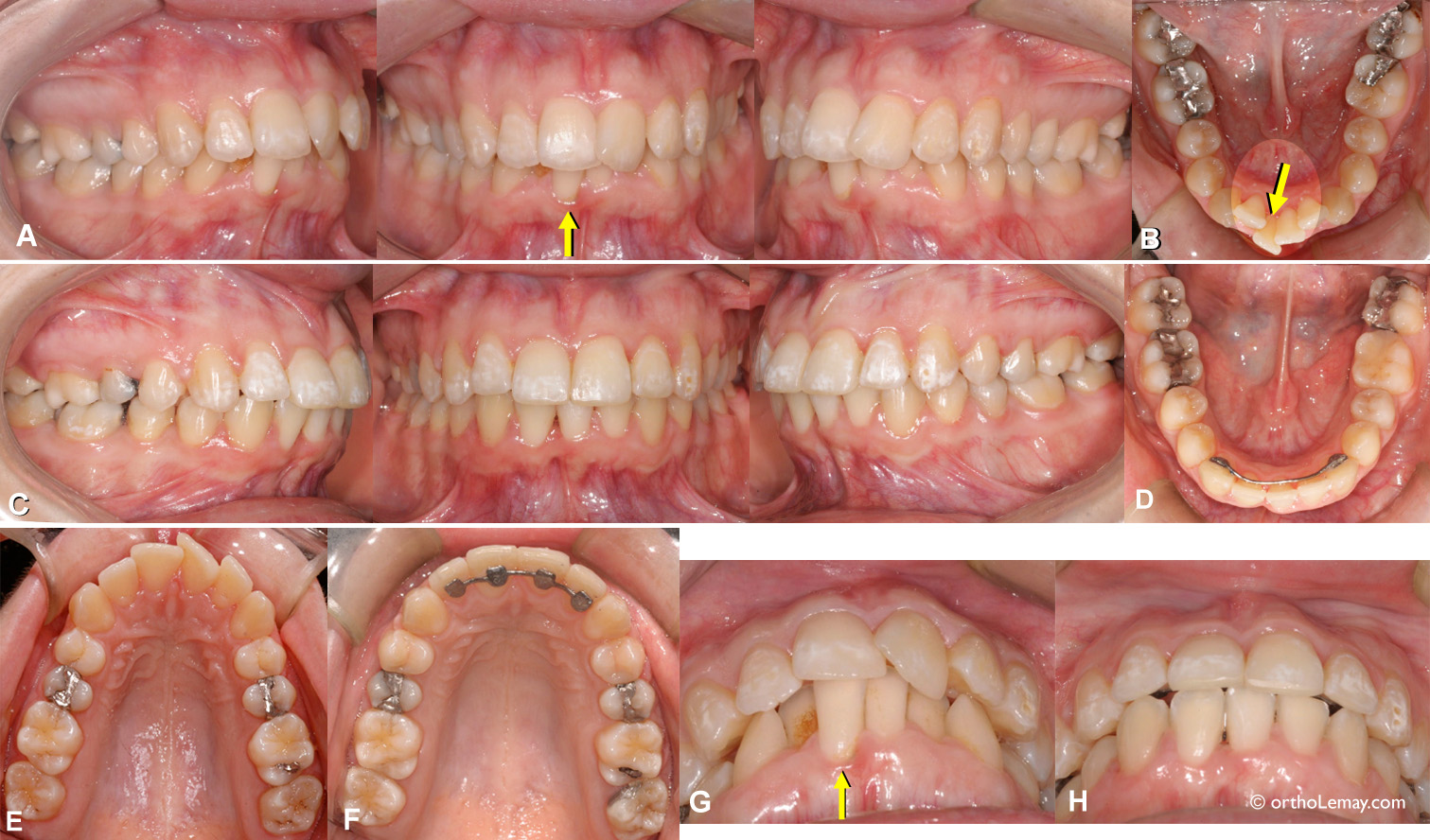 Extraction d'une incisive inférieure en présence de chevauchement dentaire pour faire des corrections orthodontiques. Lower incisor extraction for orthodontic coeerction of lower anterior crowding.