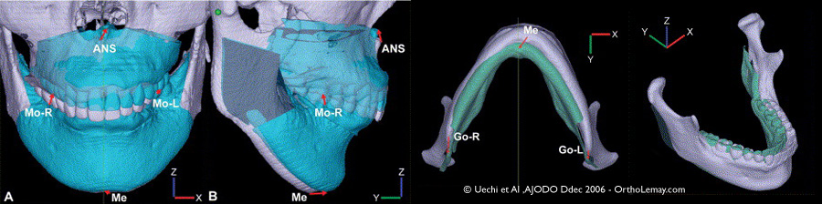 Planification virtuelle de chirurgie orthognathique à l'aide s,Un scan 3d CBCT