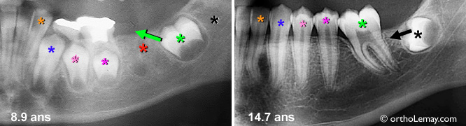 Extraction d'une molaire et migration des autres dents pendant l'éruption dentaire. Formation de la dent de sagesse. 