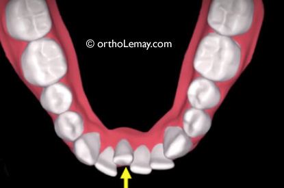 Simulation de traitement d'orthodontie avec aligneurs transparents Invisalign ou ClearCorrect avec l'extraction d'une incisive inférieure. 