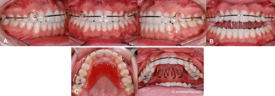 Hawley tongue crib, appareil de rétention pour contenir la langue. 