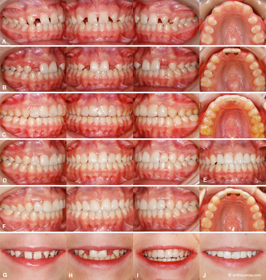 Ouverture d'espace pour remplacer des incisives latérales manquantes congénitalement.