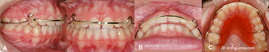 Hawley avec élastique pour rétraction des dents antérieures.