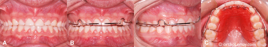 Hawley bite plane ou plan articulé utilisé en rétention orthodontique pour le bruxisme et l'usure dentaire. 