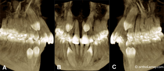 Imagerie tri-dimensionnelle par tomodensitométrie volumique à faisceau conique de 4 canines incluses.