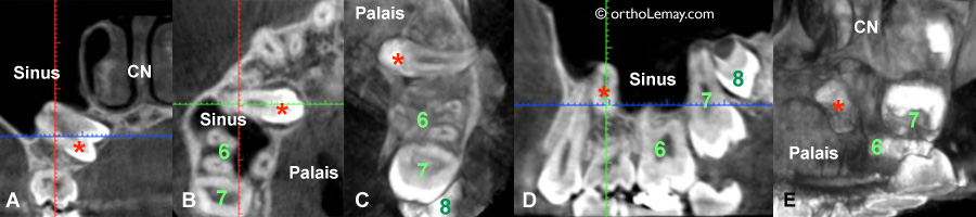 CBCT, tomodensitométrie volumique à faisceau conique (TVFC) d'une dent incluse avant la traction orthodontique 