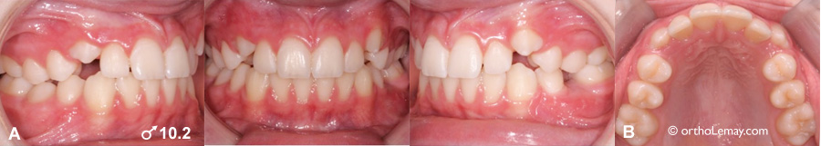 Éruption dentaire précoce rapide orthodontie 537755 TH9