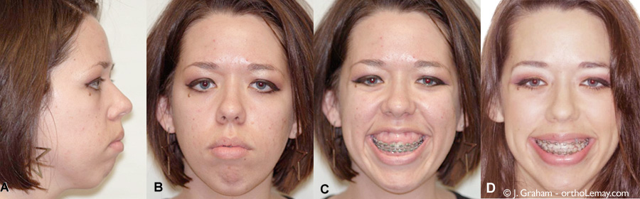 Sourire gingival de 10 mm diminué par ingression ou intrusion orthodontique avec mini-vis d’ancrage. 