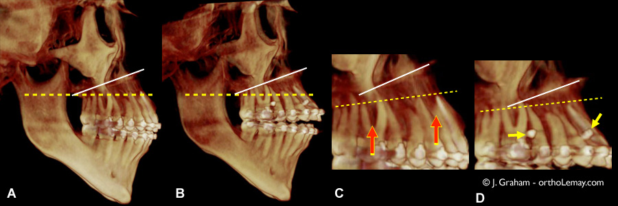 tomodensitométrie volumique à faisceau conique (TVFC) CBCT montrant le résultat de l'ingressionorthodontique à l'aide de mini-vis d’ancrage. Cas traité par John Graham, Phoenix, AZ