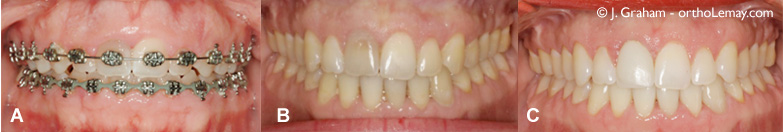 Correction d'un sourire gingival en orthodontie. Dr John Graham.