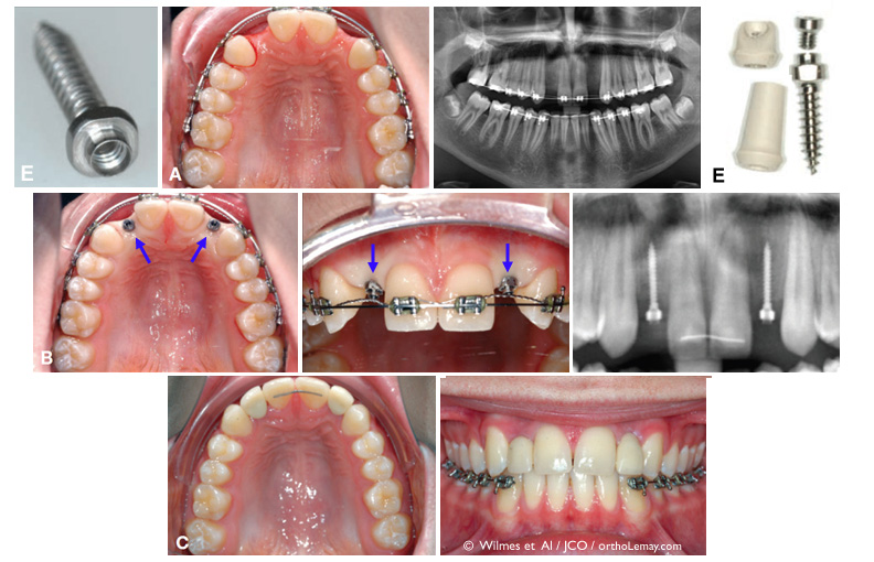 Utilisation de mini-vis d’ancrage pour supporter une couronne et préserver l'os alvéolaire après un traitement d'orthodontie