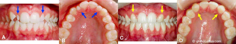 Incisives latérales étroites, courtes et difformes extraites pour être remplacées par les canines.