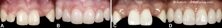 Restaurations dentaires pour remplacer des incisives latérales manquantes en orthodontie et prosthodontie