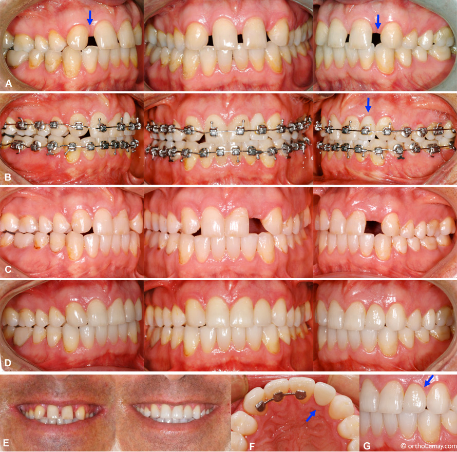 Corrections orthodontiques pour combler des espaces où des incisives latérales sont absentes (anodontie).