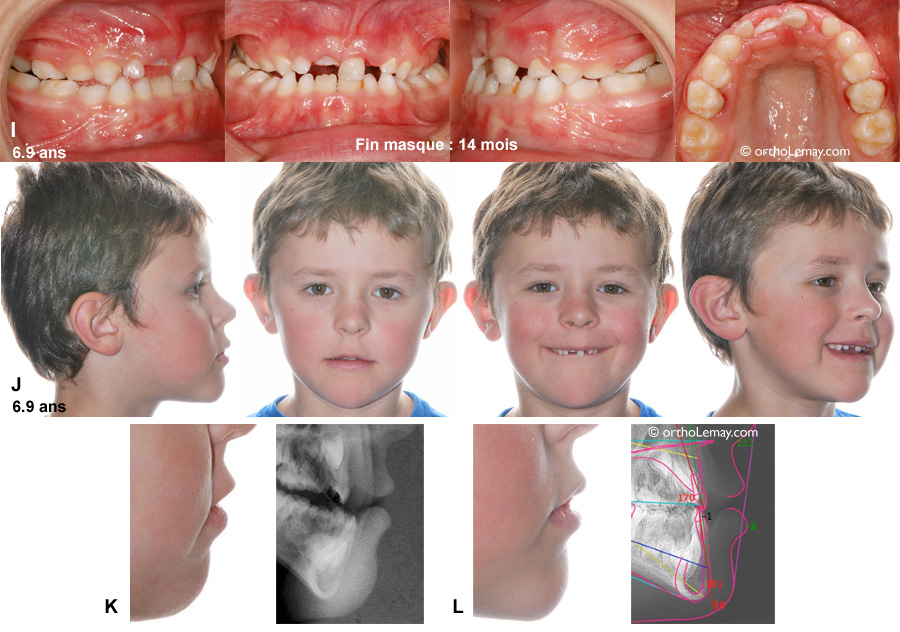 Changement dans le profil avec l'utilisatin d'un masque Delaire en orthodontie chez un jeune garçon