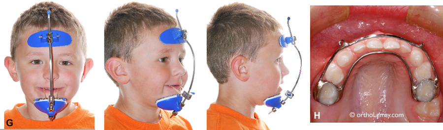 Masque de traction extra-oral Delaire utilisé pour corriger une sévère malocclusion classe 3 chez un jeune enfant