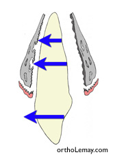 éplacement des dents en orthodontie è l'aide de résorption et déposition d'os. Ce processus est affecté par les bisphosphonates. 