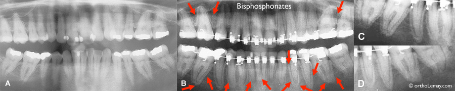 Effet des bisphosphonates sur la densité osseuse pendant un traitement d'orthodontie