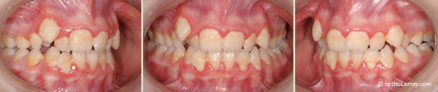 Mauvaise hygiène buccale, accumulation de plaque dentaire avant le début d'un traitement d'orthodontie. 