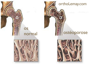 Comparaison de l'os normal et d'un os affecté par l'ostéoporose (hanche)