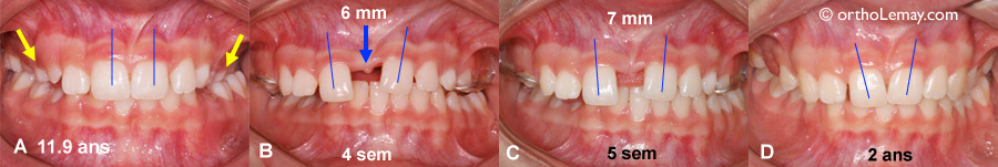 Déplacement des incisives pendant l'expansion maxillaire rapide en orthodontie
