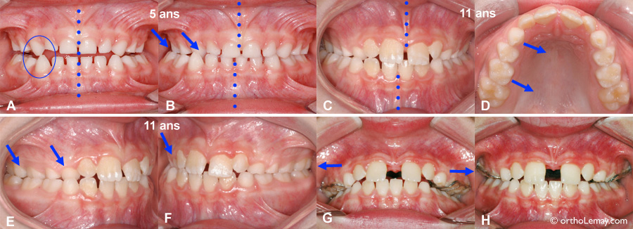 Une occlusion croisée et déviation mandibulaire ne se corrigeront pas avec la croissance sans correction orthodontique.